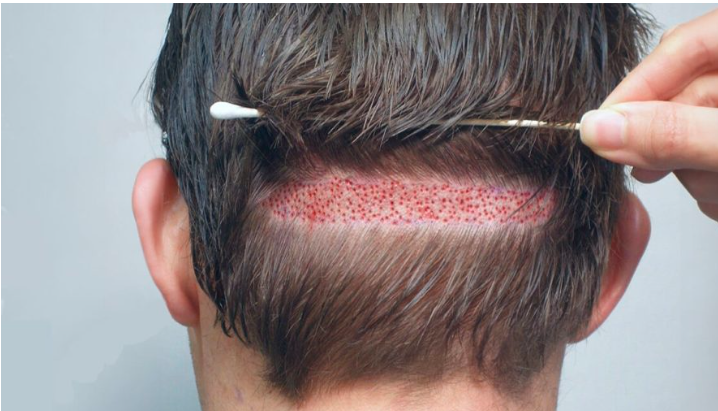 Hair Transplant in Pakistan